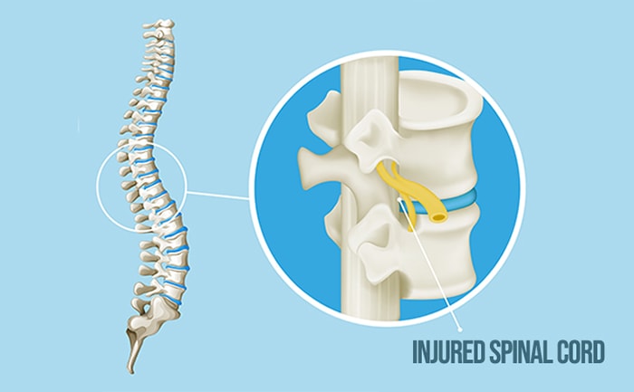 Spinal Cord Injury | Types Of Spinal Cord Injuries | SpinalCord.com